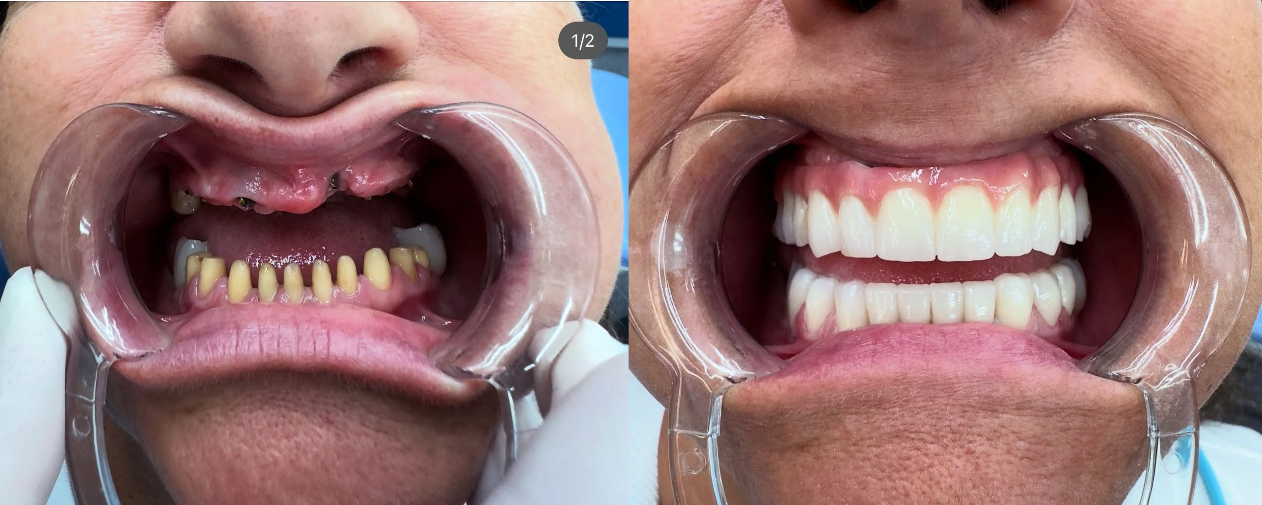 Impianti dentali prima e dopo — Luminedent Albania