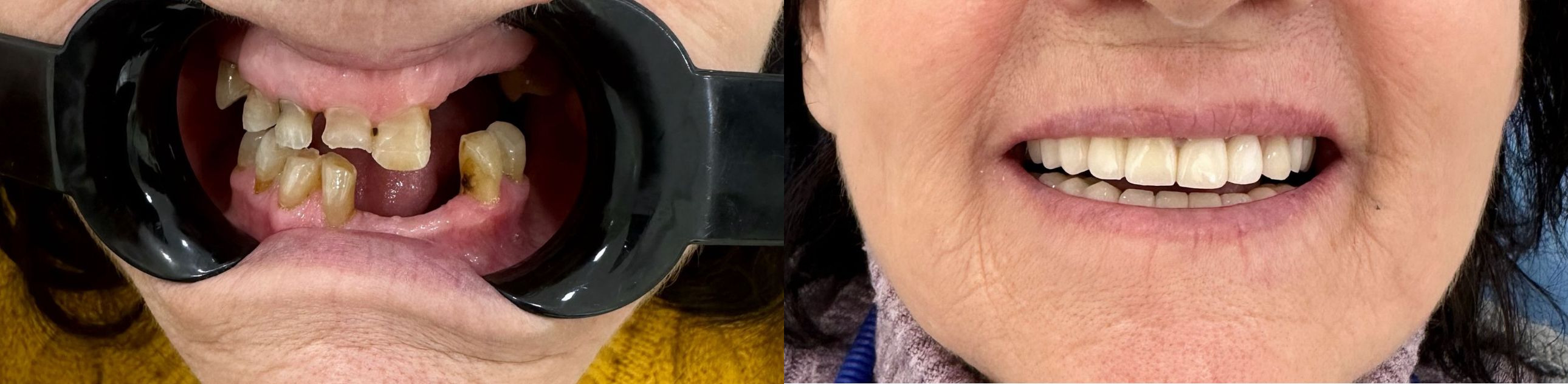 Faccette dentali prima e dopo — paziente italiana Luminedent Tirana